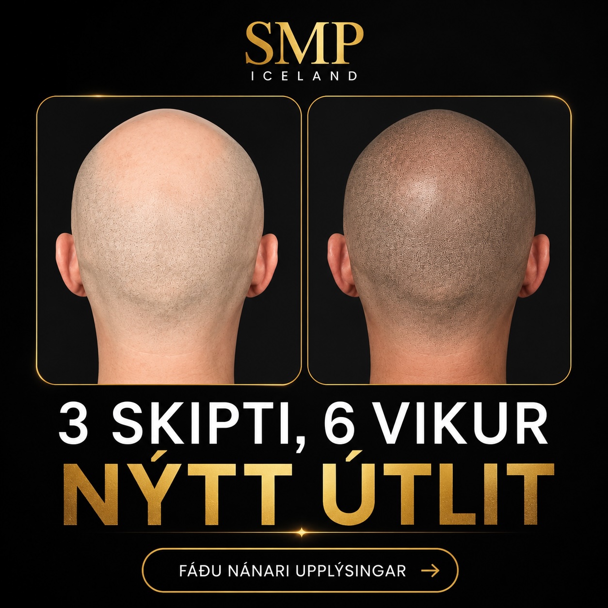 Fyrir og eftir SMP — aftanverður hársvörður