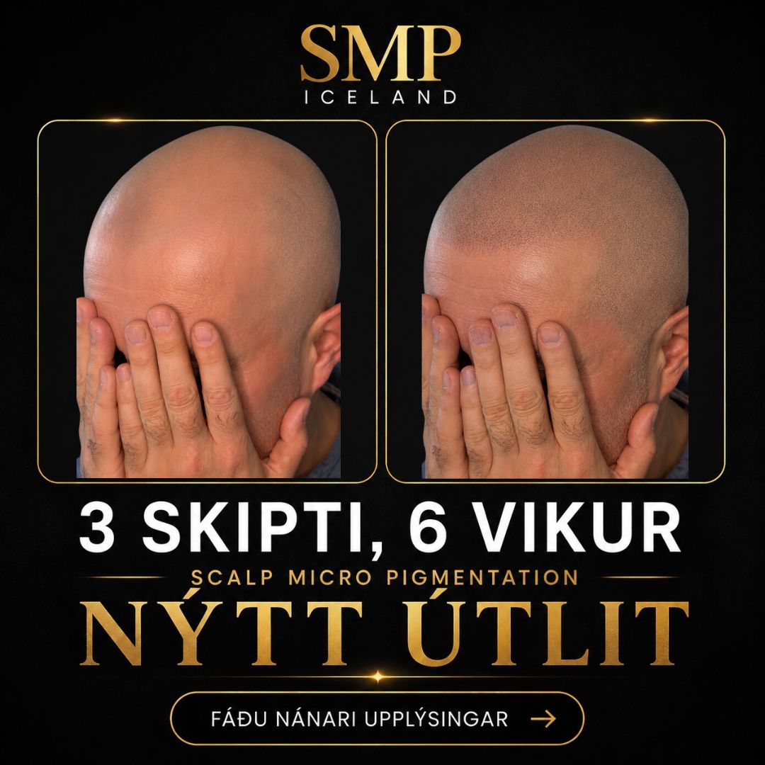 Fyrir og eftir SMP — náttúruleg hárlína