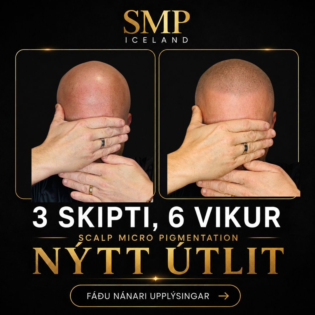 Fyrir og eftir SMP — ný hárlína